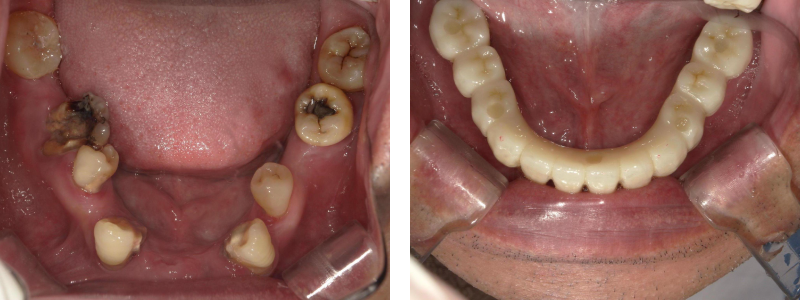 インプラント症例