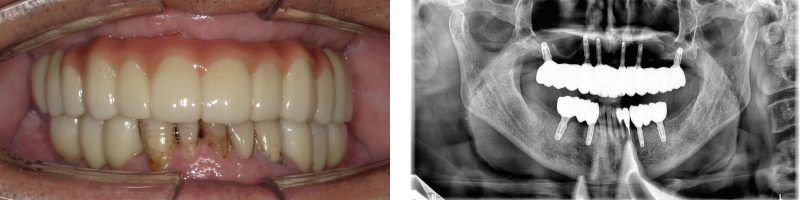 インプラント症例