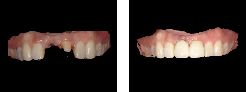 インプラント症例