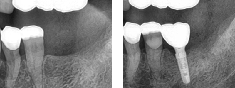 インプラント症例