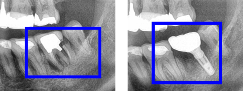 インプラント症例