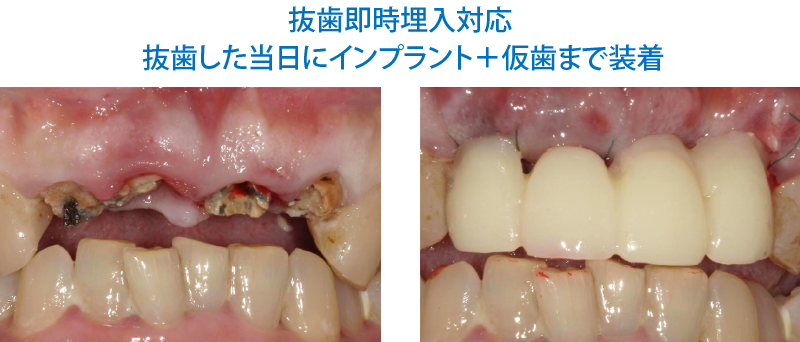 インプラント症例