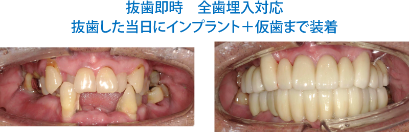 インプラント症例