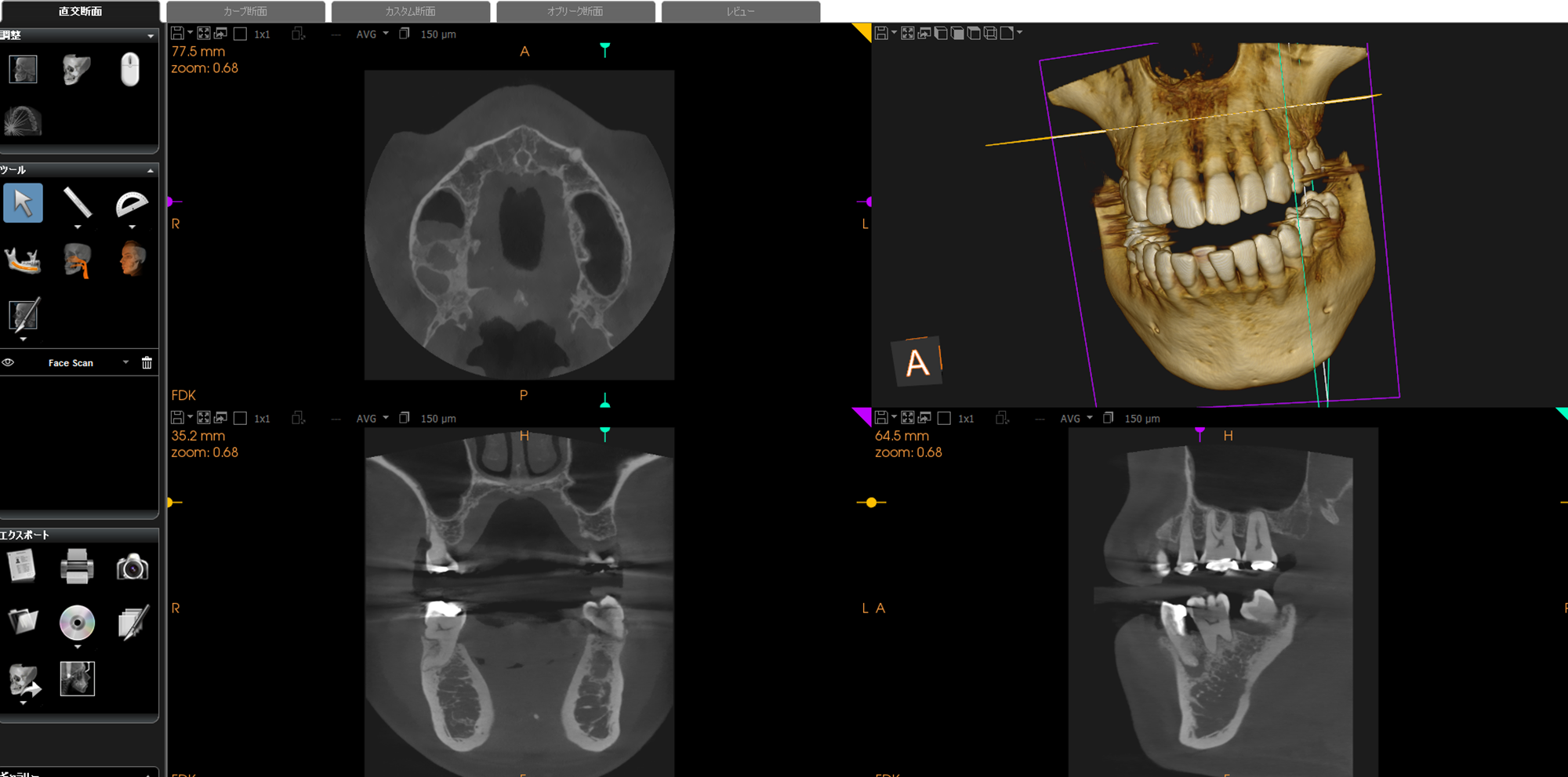 インプラントポイント