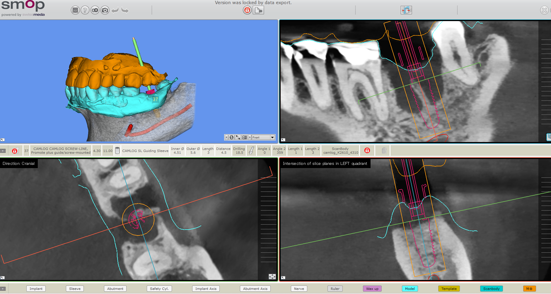 インプラントポイント