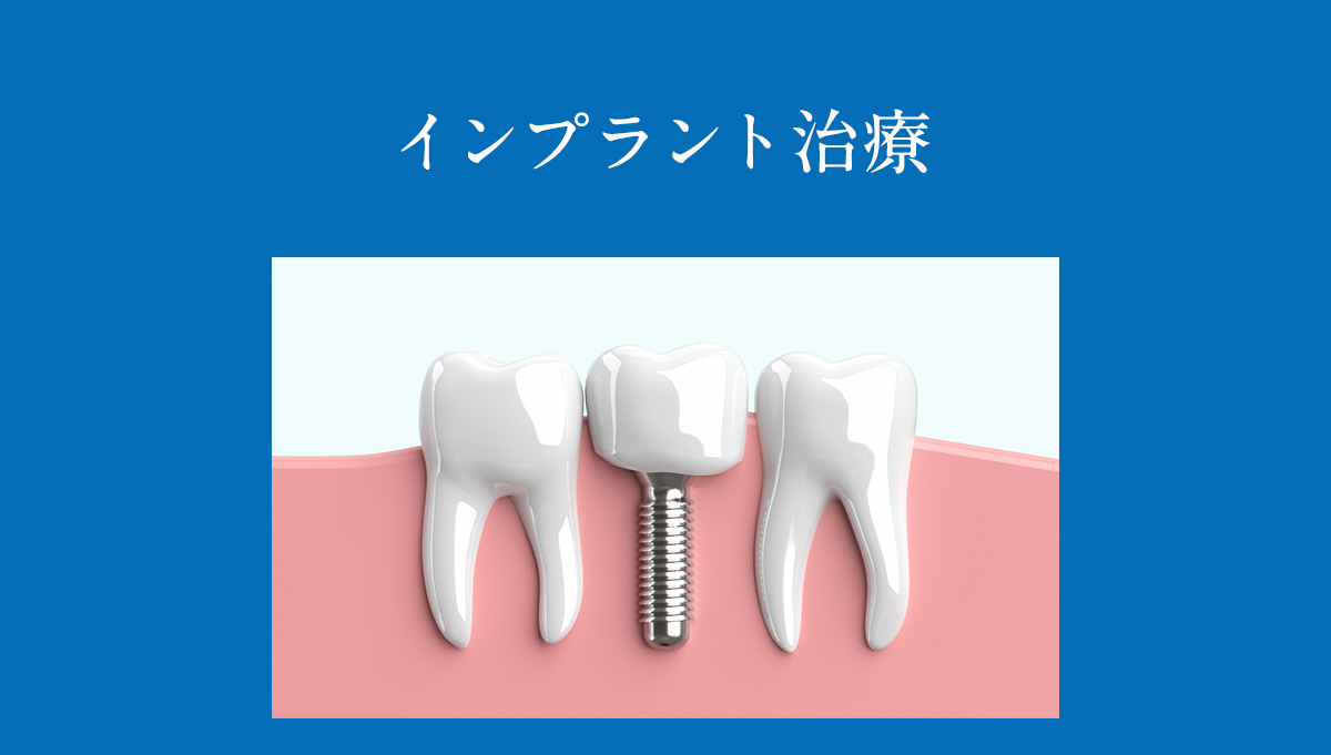 インプラント