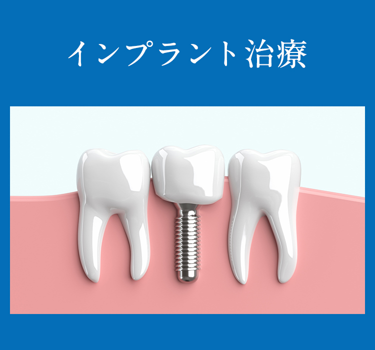 インプラント